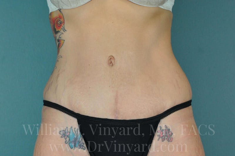 Tummy Tuck Before & After Gallery - Patient 171443133 - Image 2