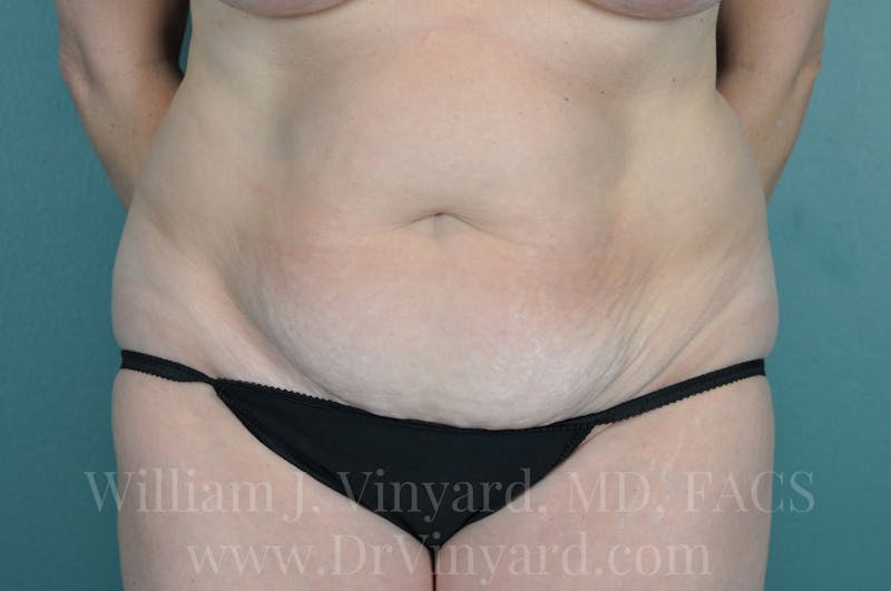 Tummy Tuck Before & After Gallery - Patient 171443152 - Image 1