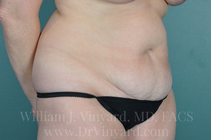 Tummy Tuck Before & After Gallery - Patient 171443152 - Image 3