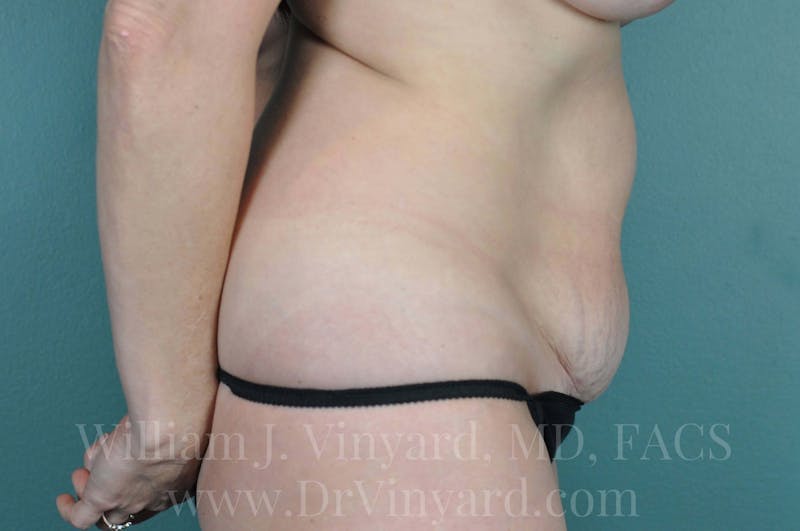 Tummy Tuck Before & After Gallery - Patient 171443152 - Image 5