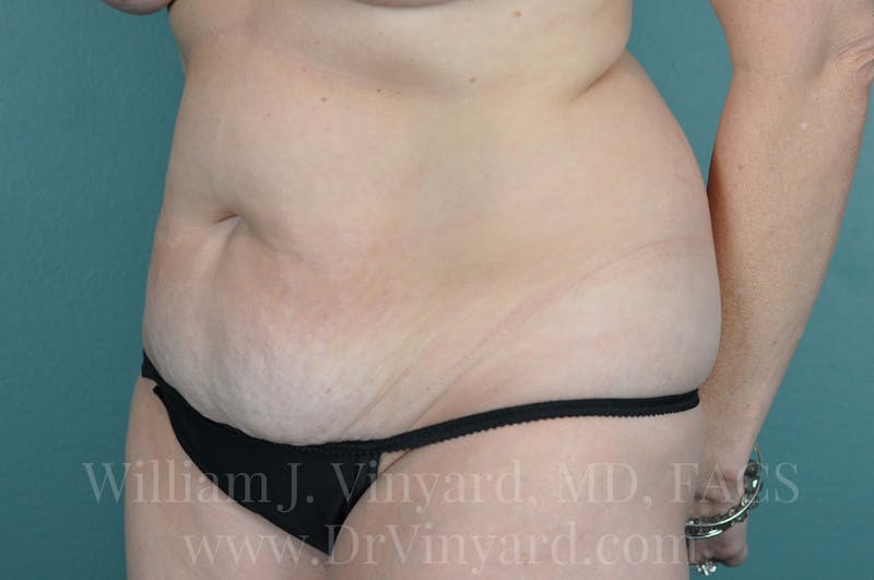 Tummy Tuck Before & After Gallery - Patient 171443152 - Image 7