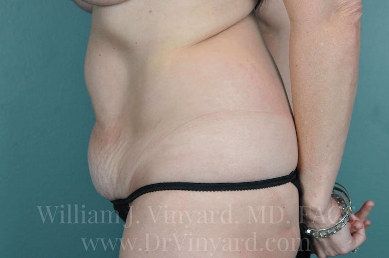 Tummy Tuck Before & After Gallery - Patient 171443152 - Image 9
