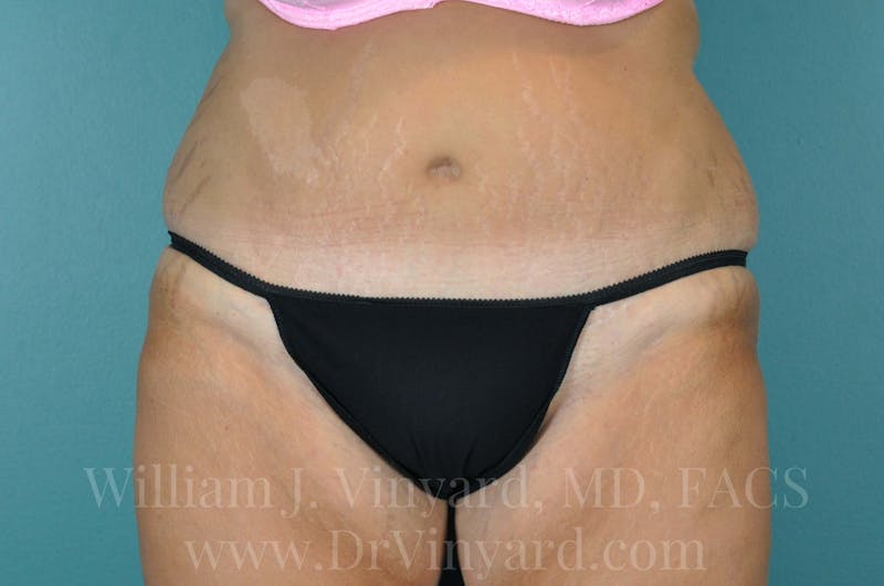 Tummy Tuck Before & After Gallery - Patient 171443187 - Image 2