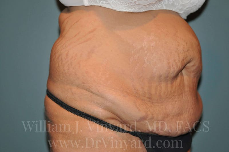 Tummy Tuck Before & After Gallery - Patient 171443187 - Image 3