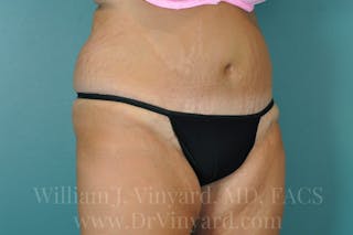 Tummy Tuck Before & After Gallery - Patient 171443187 - Image 4