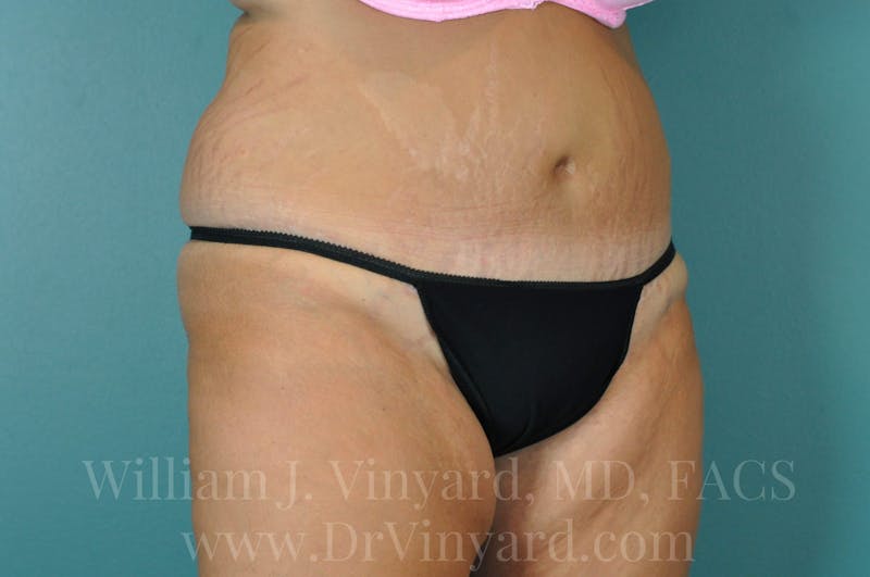 Tummy Tuck Before & After Gallery - Patient 171443187 - Image 4
