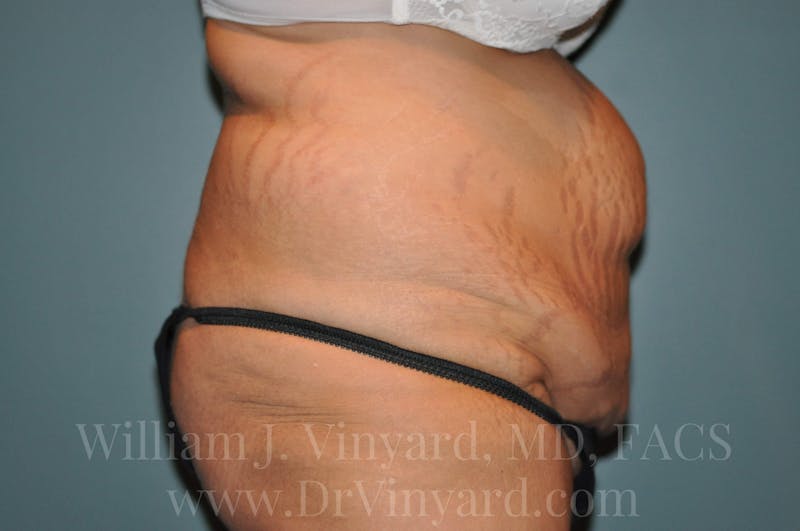 Tummy Tuck Before & After Gallery - Patient 171443187 - Image 5