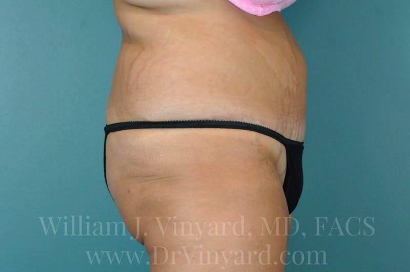 Tummy Tuck Before & After Gallery - Patient 171443187 - Image 6