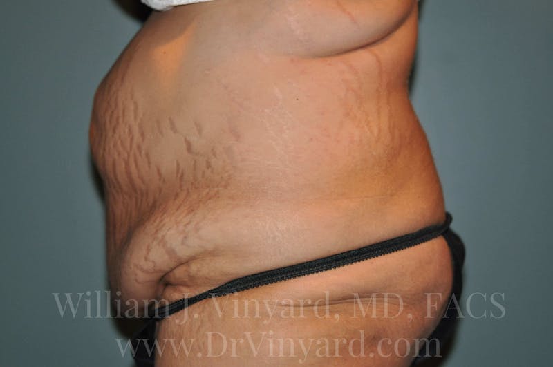 Tummy Tuck Before & After Gallery - Patient 171443187 - Image 9
