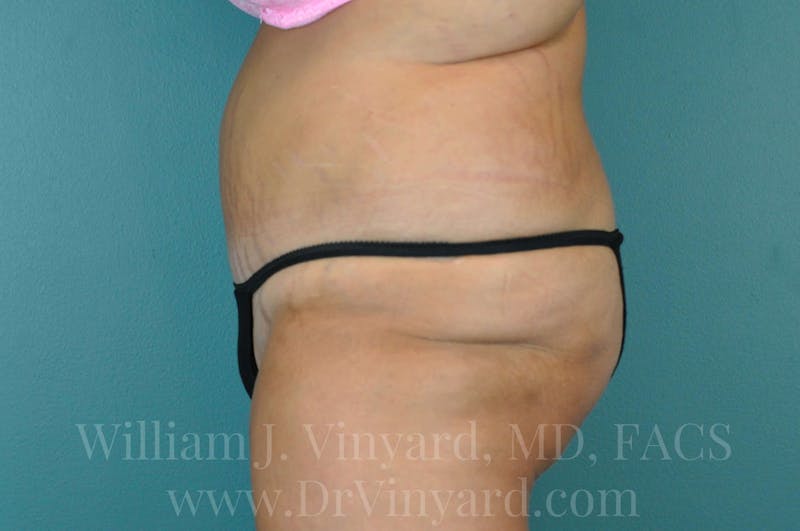 Tummy Tuck Before & After Gallery - Patient 171443187 - Image 10