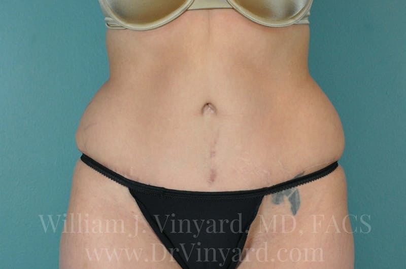 Tummy Tuck Before & After Gallery - Patient 171443244 - Image 2