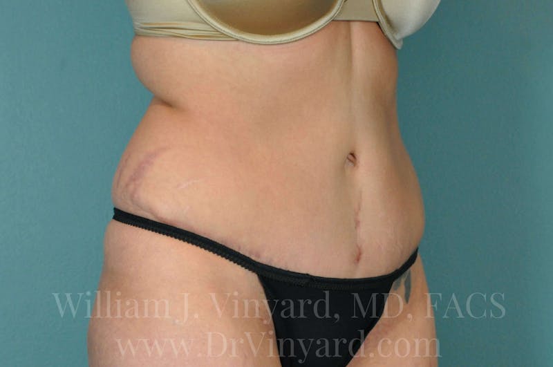 Tummy Tuck Before & After Gallery - Patient 171443244 - Image 4