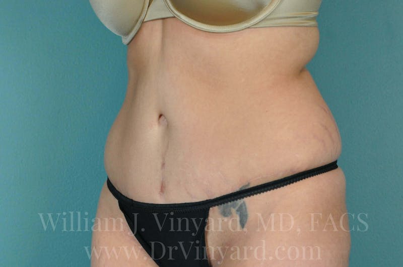 Tummy Tuck Before & After Gallery - Patient 171443244 - Image 8