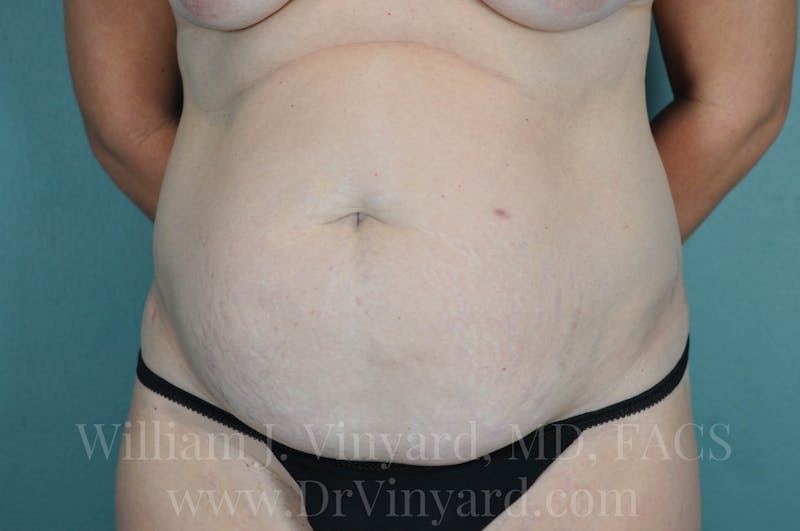 Tummy Tuck Before & After Gallery - Patient 171443685 - Image 1