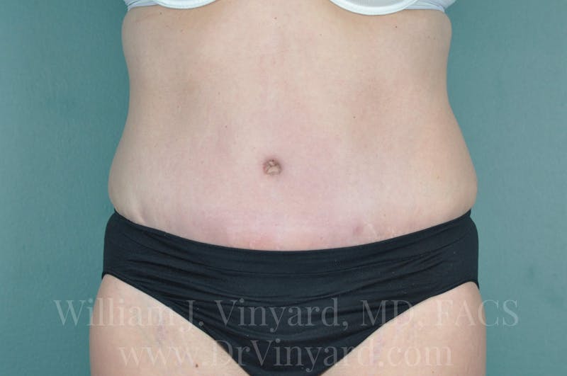Tummy Tuck Before & After Gallery - Patient 171443685 - Image 2