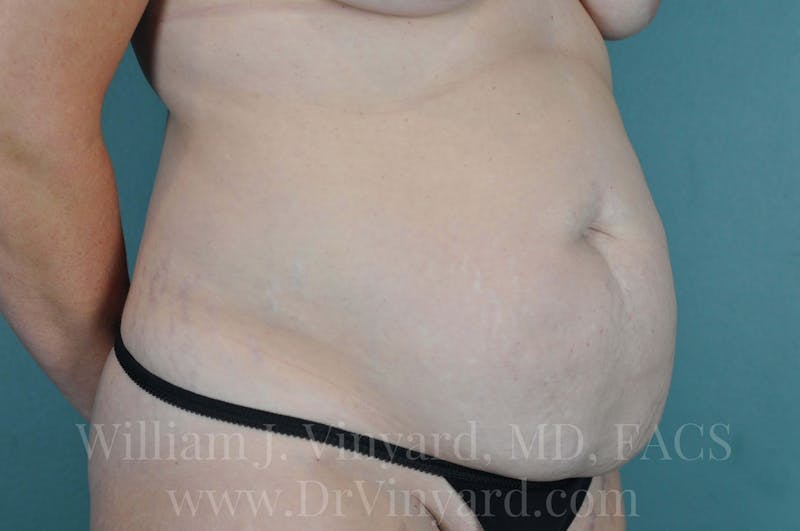Tummy Tuck Before & After Gallery - Patient 171443685 - Image 3