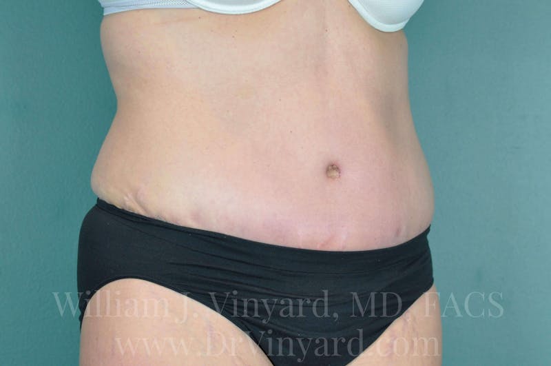 Tummy Tuck Before & After Gallery - Patient 171443685 - Image 4