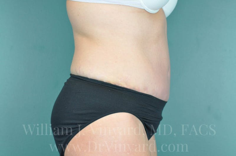 Tummy Tuck Before & After Gallery - Patient 171443685 - Image 6