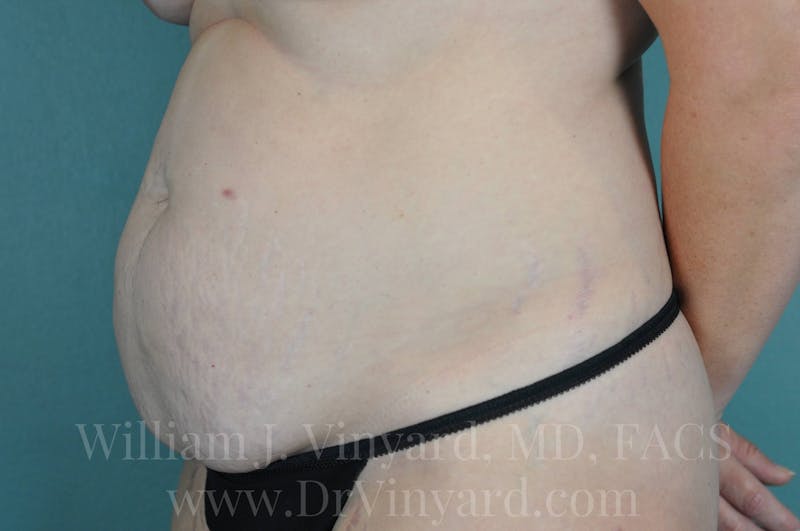 Tummy Tuck Before & After Gallery - Patient 171443685 - Image 7