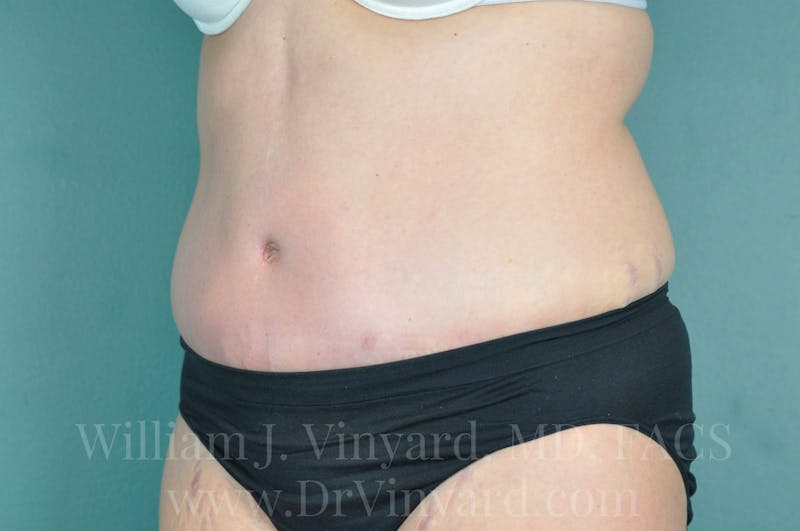 Tummy Tuck Before & After Gallery - Patient 171443685 - Image 8
