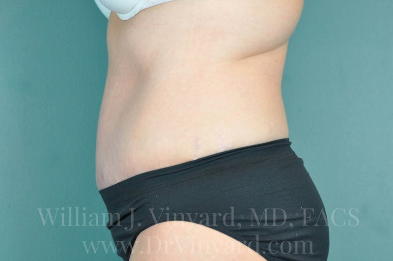 Tummy Tuck Before & After Gallery - Patient 171443685 - Image 10