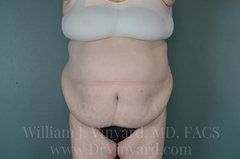 Tummy Tuck Before & After Gallery - Patient 171443716 - Image 1