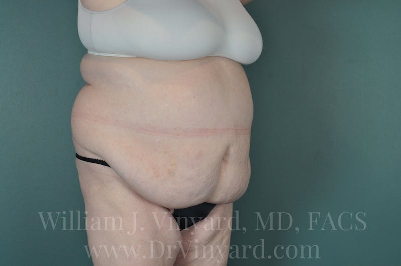 Tummy Tuck Before & After Gallery - Patient 171443716 - Image 3