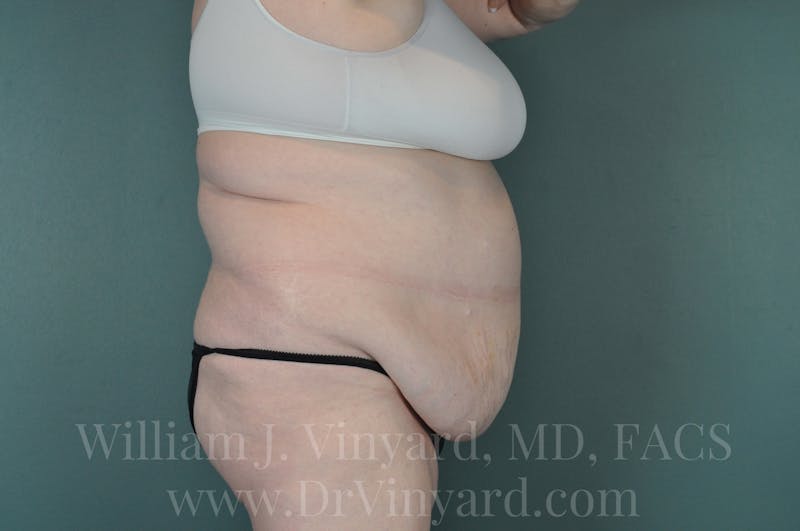 Tummy Tuck Before & After Gallery - Patient 171443716 - Image 5