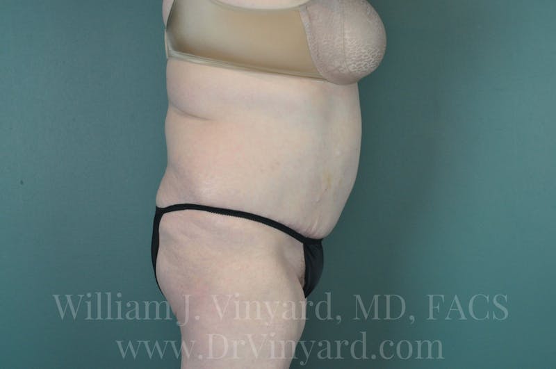 Tummy Tuck Before & After Gallery - Patient 171443716 - Image 6