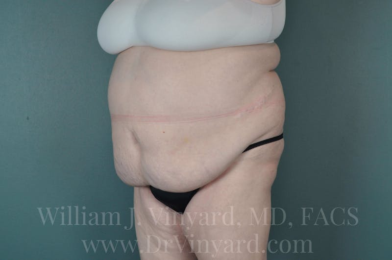 Tummy Tuck Before & After Gallery - Patient 171443716 - Image 7