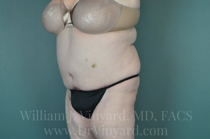 Tummy Tuck Before & After Gallery - Patient 171443716 - Image 8
