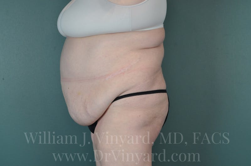 Tummy Tuck Before & After Gallery - Patient 171443716 - Image 9