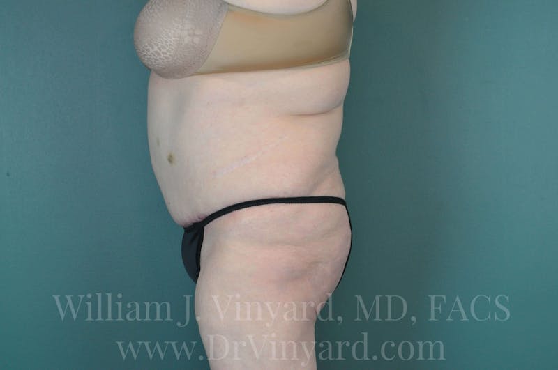 Tummy Tuck Before & After Gallery - Patient 171443716 - Image 10