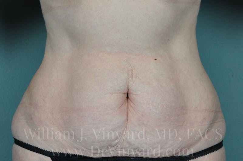 Tummy Tuck Before & After Gallery - Patient 171443726 - Image 1
