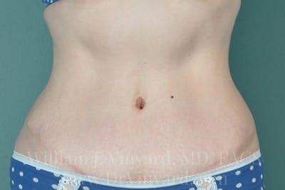 Tummy Tuck Before & After Gallery - Patient 171443726 - Image 2