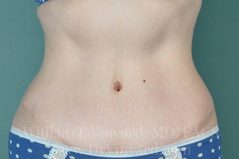 Tummy Tuck Before & After Gallery - Patient 171443726 - Image 2