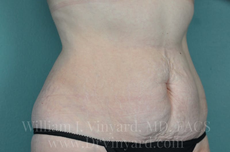 Tummy Tuck Before & After Gallery - Patient 171443726 - Image 3