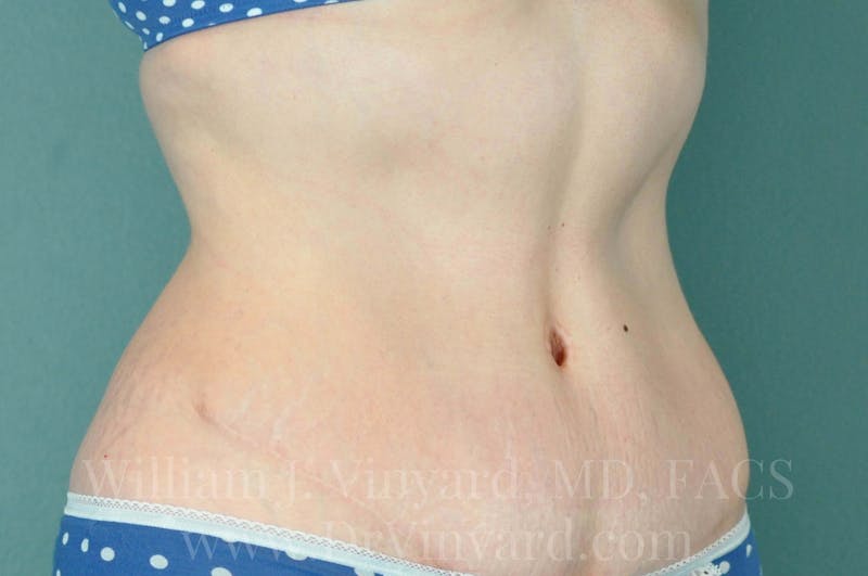 Tummy Tuck Before & After Gallery - Patient 171443726 - Image 4