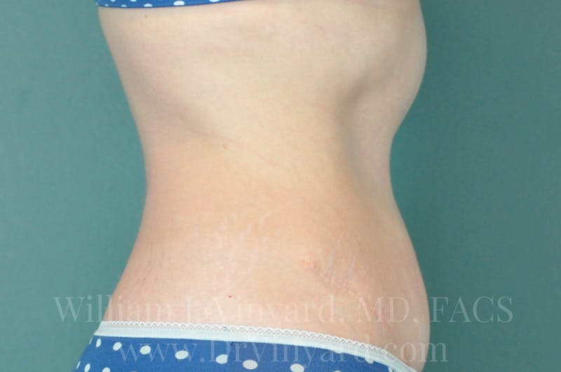 Tummy Tuck Before & After Gallery - Patient 171443726 - Image 6