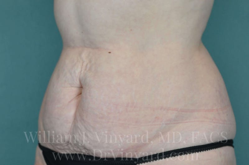 Tummy Tuck Before & After Gallery - Patient 171443726 - Image 7