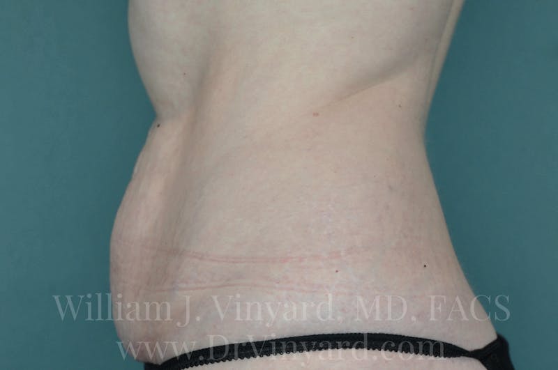Tummy Tuck Before & After Gallery - Patient 171443726 - Image 9