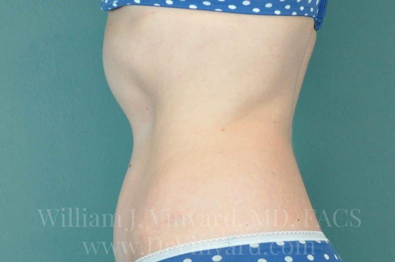 Tummy Tuck Before & After Gallery - Patient 171443726 - Image 10