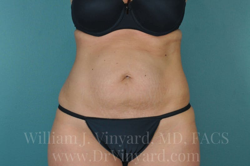Tummy Tuck Before & After Gallery - Patient 171443738 - Image 1