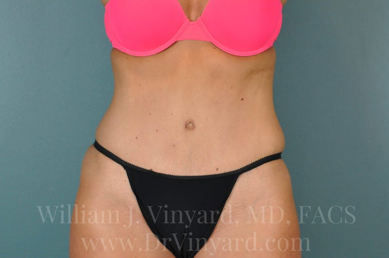 Tummy Tuck Before & After Gallery - Patient 171443738 - Image 2
