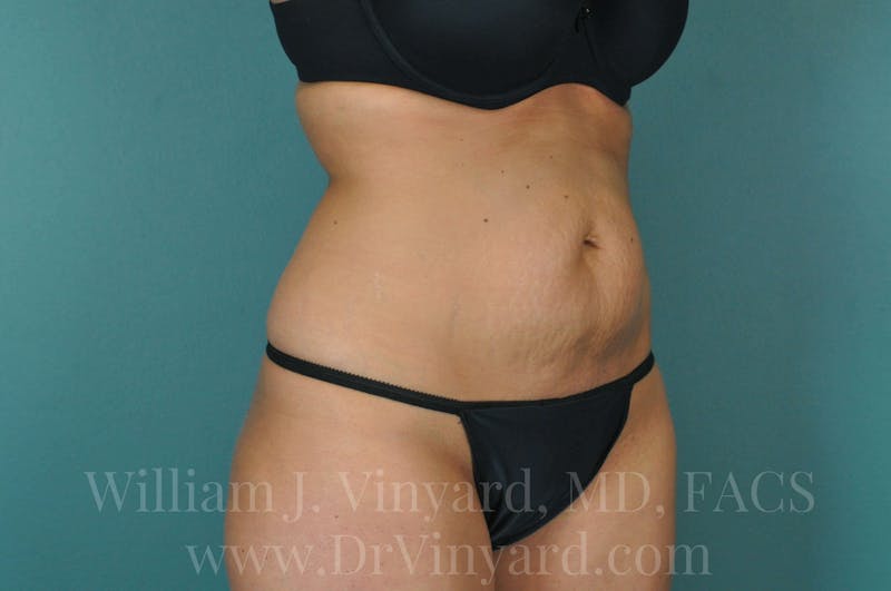 Tummy Tuck Before & After Gallery - Patient 171443738 - Image 3