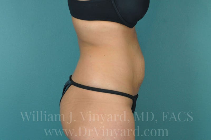 Tummy Tuck Before & After Gallery - Patient 171443738 - Image 5