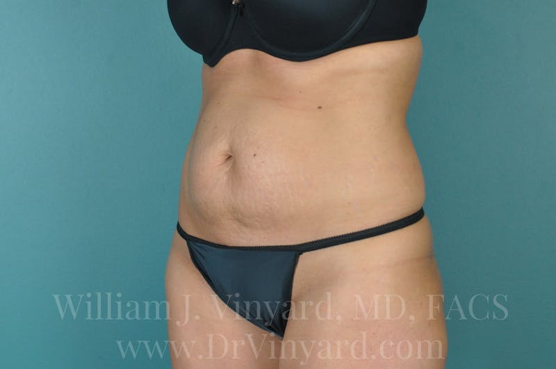Tummy Tuck Before & After Gallery - Patient 171443738 - Image 7