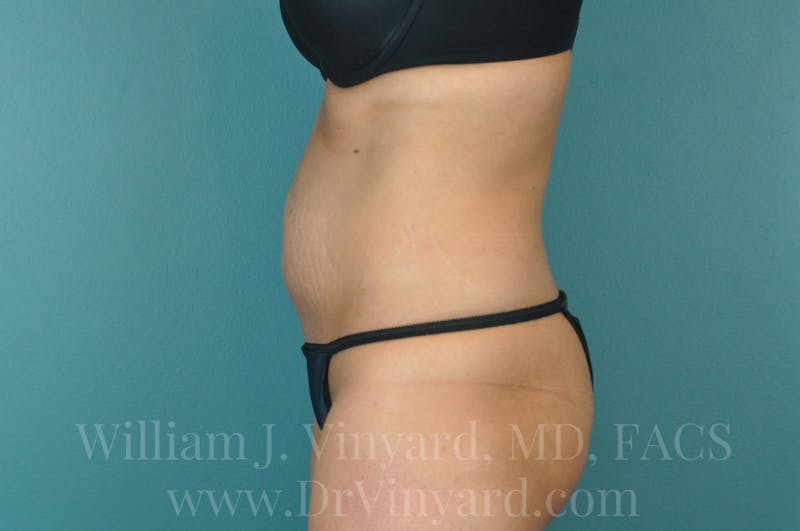 Tummy Tuck Before & After Gallery - Patient 171443738 - Image 9