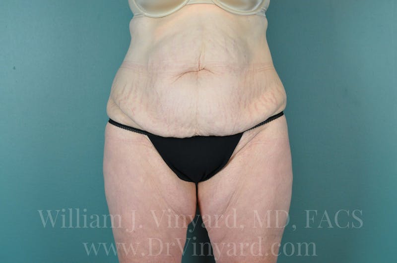Tummy Tuck Before & After Gallery - Patient 171444238 - Image 1