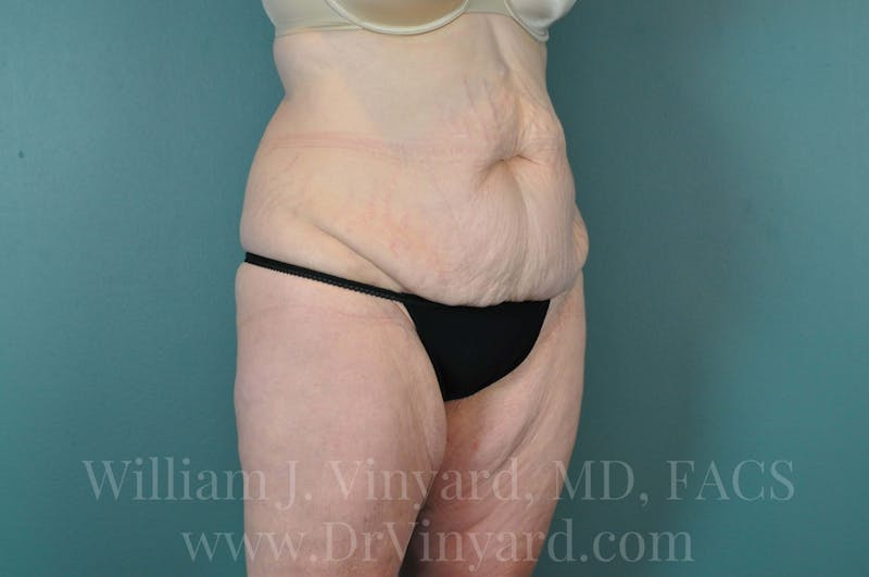 Tummy Tuck Before & After Gallery - Patient 171444238 - Image 3
